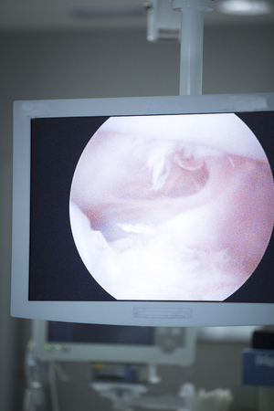 Traumatology orthopedic surgery hospital emergency operating room prepared for arthroscopy operation showing screen to view micro camera images.の写真素材