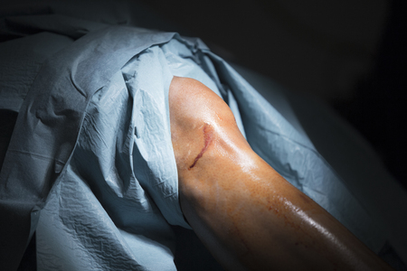 Traumatology orthopedic surgery hospital emergency operating room prepared for knee torn meniscus arthroscopy operation photo.の写真素材