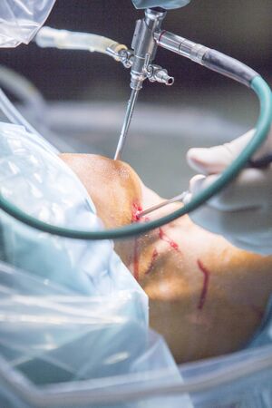 Traumatology orthopedic surgery hospital emergency operating room prepared for knee torn meniscus arthroscopy operation photo of drip fluids tube, arthroscope, arthroscopy camera and probe.の写真素材