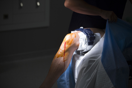 Traumatology orthopedic surgery hospital emergency operating room prepared for knee torn meniscus arthroscopy operation photo anaesthetic injection.の写真素材