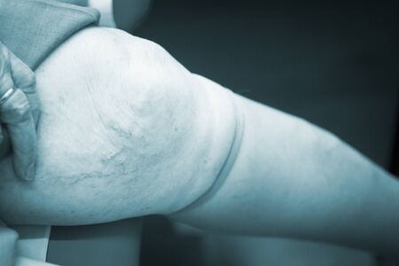 Patient leg in physical therapy physiotherapy clinic in medical center hospital rehabilitation room.の写真素材