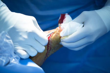 Hospital emergency orthopedics and traumatology surgery operating room medical clinic real life photo in foot, ankle and leg arthroscopy orthopedic operation.の写真素材