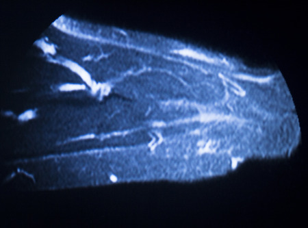 MRI magnetic resonance imaging medical scan test results showing ligaments, cartilege and cross...