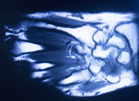 MRI magnetic resonance imaging medical scan test results of hand and fingers showing ligaments, cartilege and cross section of bones in human skeleton.の写真素材