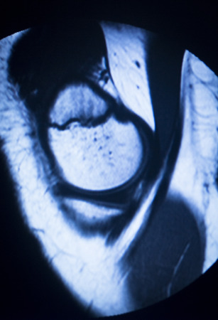 MRI magnetic resonance imaging medical scan test results showing knee joint, meniscus, femur, thigh and calf of leg, ligaments, cartilege and cross section of bones in human skeleton.の写真素材