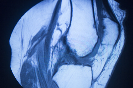 MRI magnetic resonance imaging medical scan test results showing knee joint, meniscus, femur, thigh and calf of leg, ligaments, cartilege and cross section of bones in human skeleton.の写真素材