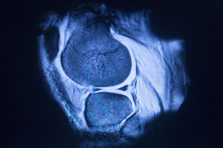 MRI magnetic resonance imaging medical scan test results showing knee joint, meniscus, femur, thigh...