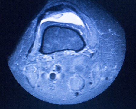 MRI magnetic resonance imaging medical scan test results showing ligaments, cartilege and cross section of bones in human skeleton.の写真素材