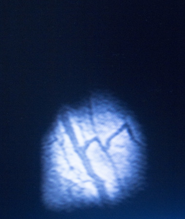 MRI magnetic resonance imaging medical scan test results of hand and fingers showing ligaments,...
