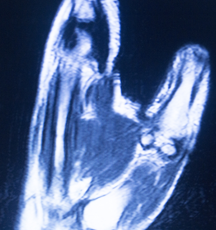 MRI magnetic resonance imaging medical scan test results showing ligaments, cartilege and cross section of bones in human skeleton o hand and fingers.の写真素材