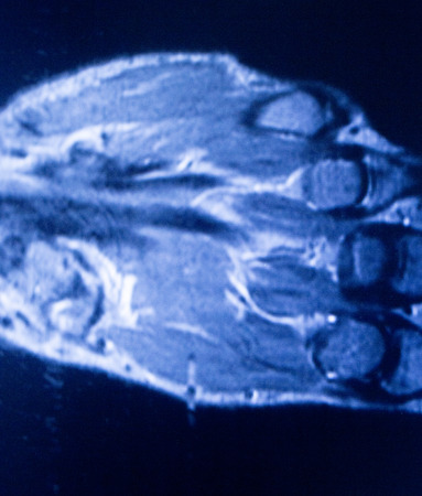 MRI magnetic resonance imaging medical scan test results of hand and fingers showing ligaments, cartilege and cross section of bones in human skeleton.の写真素材