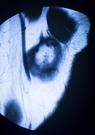 MRI magnetic resonance imaging medical scan test results showing knee joint, meniscus, femur, thigh and calf of leg, ligaments, cartilege and cross section of bones in human skeleton.の写真素材