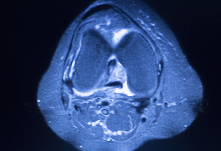 MRI magnetic resonance imaging medical scan test results showing ligaments, cartilege and cross...