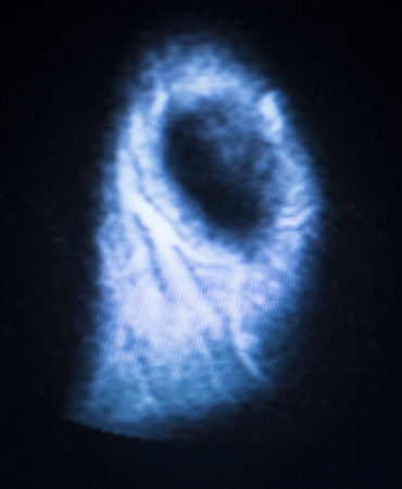 MRI magnetic resonance imaging medical scan test results showing ligaments, cartilege and cross...