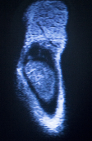 MRI magnetic resonance imaging medical scan test elbow results showing ligaments, cartilege and...