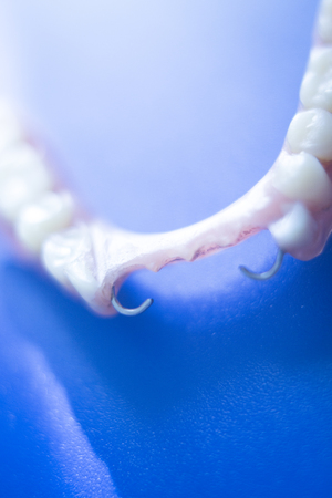 Removable partial denture metal and plastic dental false teeth prosthetics.