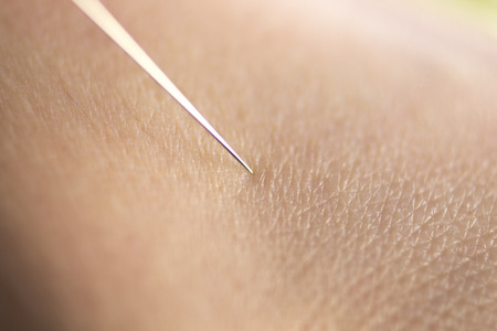 Acupuncture needle used for dry needling rehabilitation medical treament for physiotherapy and pain...