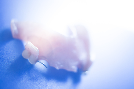 Removable partial denture metal and plastic dental false teeth prosthetics.の写真素材