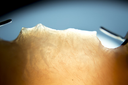 Removable partial denture metal and plastic dental false teeth prosthetic.の写真素材