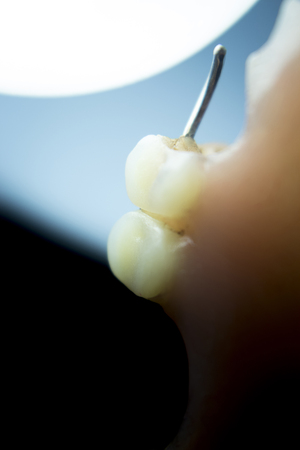Removable partial denture metal and plastic dental false teeth prosthetic.