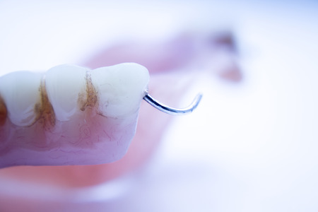 Removable partial denture metal and plastic dental false teeth prosthetic.の写真素材