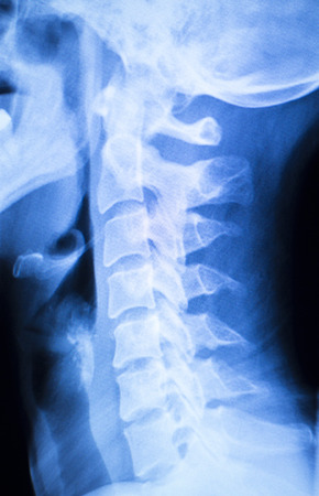 Painful neck and spine injury x-ray scan Traumatology and orthopedics test results.