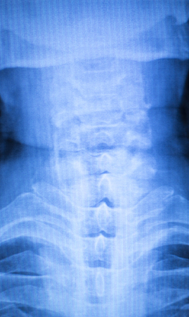 Painful neck and spine injury x-ray scan Traumatology and orthopedics test results.