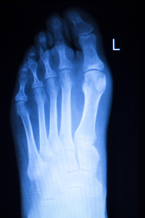 Foot and toes injury x-ray scan orthopedics and Traumatology radiology test results photo.の写真素材