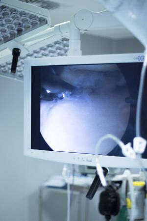 Hospital keyhole micro surgery arthroscopy operation screen showing arthroscope camera internal body image photo.の写真素材