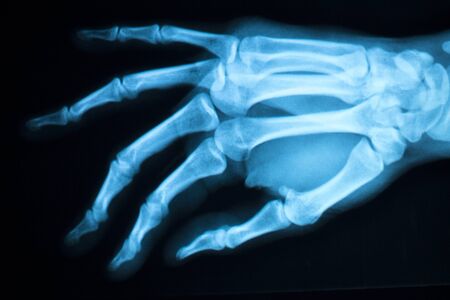 Hand, fingers and thumb hospital x-ray scan test results for joint pain and injury in orthopedic...