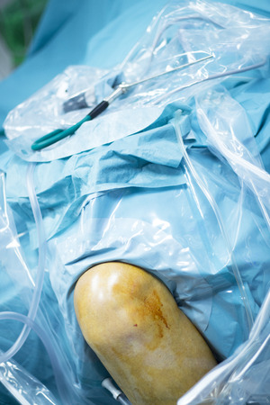 Knee arthroscopy orthopedic surgery operation in hospital emergency operating room photo.の写真素材