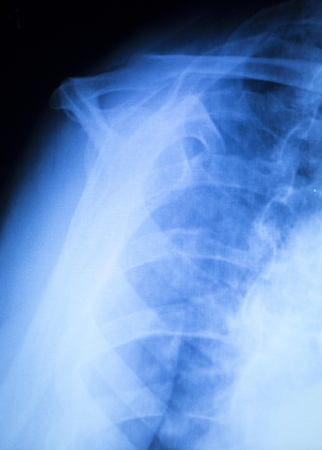 Shoulder injury orthopedics xray scan Trauamtology scanning results.