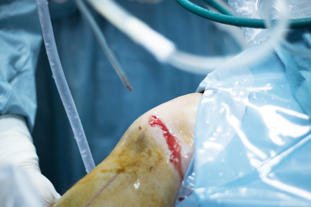 Knee arthroscopy orthopedic surgery operation in hospital operating room photo showing surgeon with arthroscopy camera and probe.の写真素材