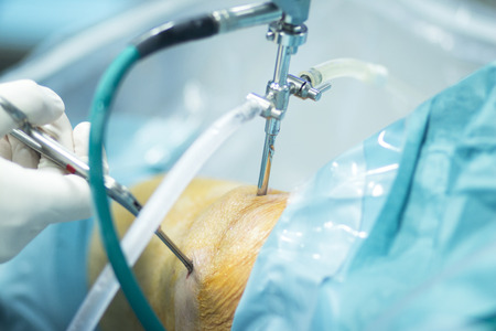 Hospital orthopedics Traumatology surgical operation on torn meniscus in knee emergency operating...
