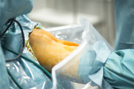 Orthopedic surgery meniscus operation hospital emergency operating room photo.の写真素材