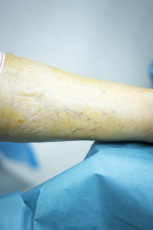 Knee arthroscopy orthopedic surgery operation in hospital emergency operating room photo.の写真素材