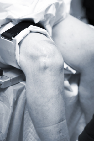 Hospital orthopedics Traumatology surgical operation on torn meniscus in knee emergency operating room photo.の写真素材