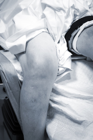 Hospital knee surgery arthroscopy orthopedic operation in emergency operating room photo.の写真素材