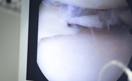 Hospital keyhole micro surgery arthroscopy operation screen showing arthroscope camera internal body image photo.の写真素材