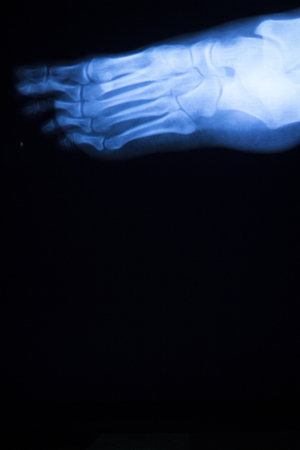 Foot and toes injury x-ray scan orthopedics and Traumatology radiology test results photo.の写真素材