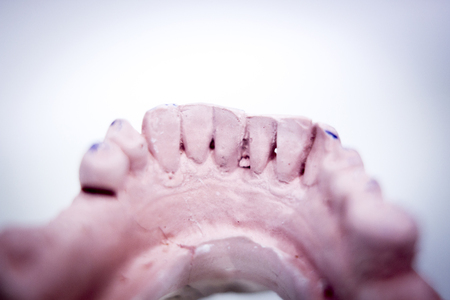 Dental prosthetics clay tooth mold in dentists photo.の写真素材