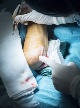 Hospital elbow and arm orthopedics surgery Traumatology operation stitching photo.の写真素材