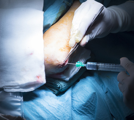 Hospital elbow and arm orthopedics surgery Traumatology operation stitching photo.の写真素材