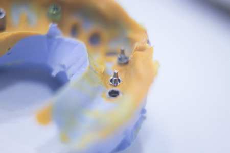 Dental mold dental impression plate in dentist's clinic.の写真素材