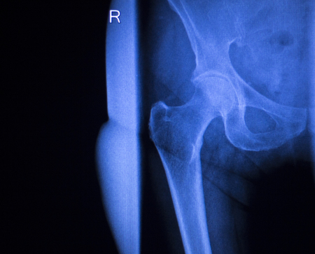 Hip, leg, thigh and pelvis injury medical x-ray test scan image of old age senior adult.の写真素材