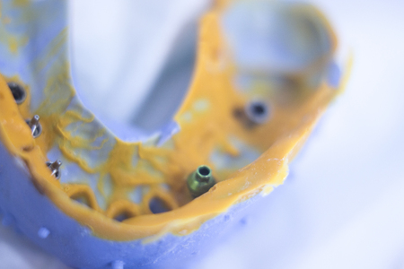 Dental mold dental impression plate in dentist's clinic.の写真素材