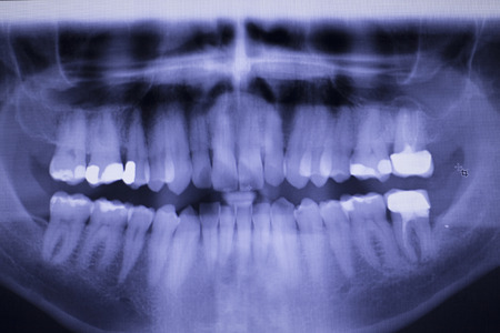 Dental teeth fillings, gum disease gingivitis dentists medical tooth x-ray test scan image.の写真素材