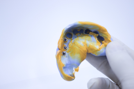 Dentists' dental teeth prosthetic mould in clinic.