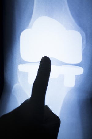 Knee and meniscus injury medical x-ray test scan result for adult showing orthopedic Traumatology titanium metal plate implant image.の写真素材