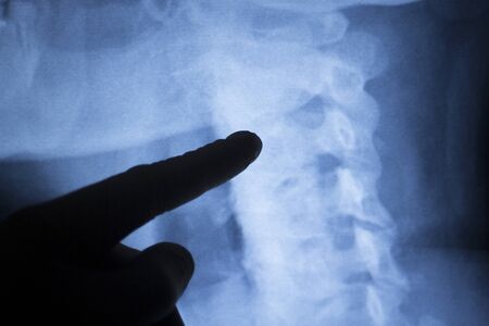 Spinal column, vertebra, neck and back medical x-ray test scan result for adult showing orthopedic...